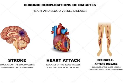 Complicaciones crónicas de la diabetes. Enfermedades del corazón y los ...