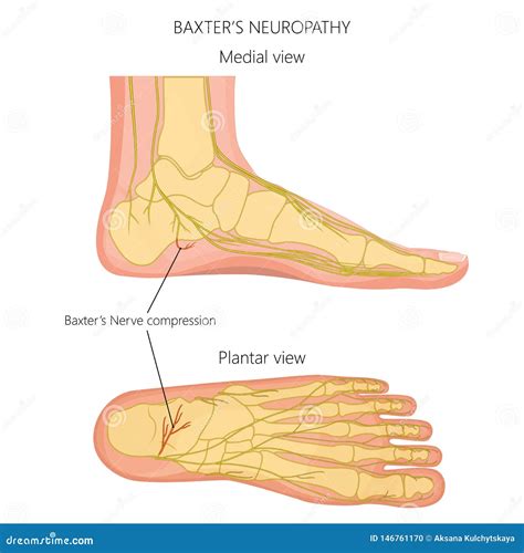 Neuroma As A Problem That Makes Life Harder - Symbolized By A Person Pushing Weight With Word ...