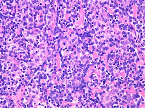 Pathology Outlines - Eccrine spiradenoma