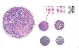 Tissue Microarray (TMA) - Cancer and Normal Arrays