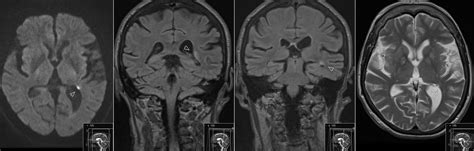 Tail of Caudate Nucleus Infarct