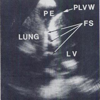 Measurement and Mechanism of Pulsus Paradoxus | Download Scientific Diagram