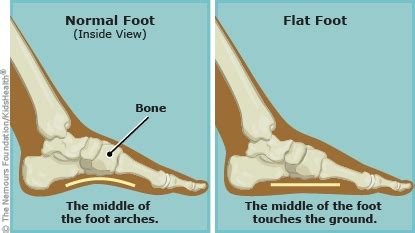 Flat Feet | Dayton Children's Hospital