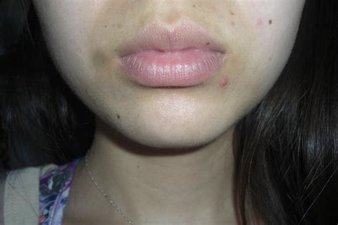 [Skin Concerns] How to fix dark discoloration around mouth? : SkincareAddiction