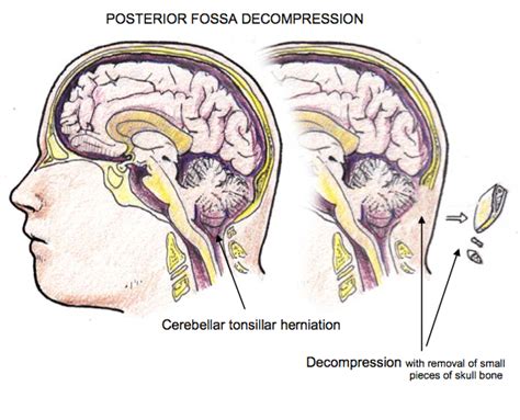 Hanging Low and Invisible: Posterior Fossa Decompression