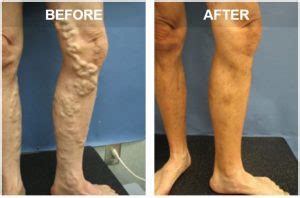 Why are my veins bulging? - Vein Specialists of the South | Vein Specialists of the South