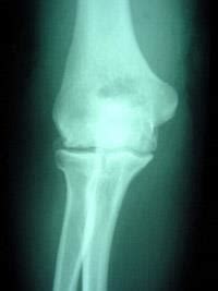 Osteoarthritis of the Elbow - OrthoInfo - AAOS