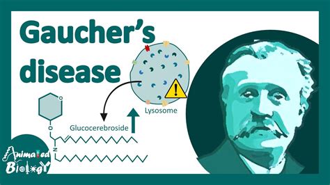 Gaucher's disease | classification, symptoms, pathology of Gaucher's ...