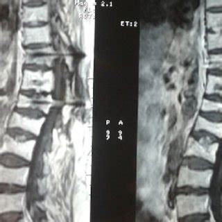 (PDF) Type IV Aggressive and Symptomatic Vertebral Hemangioma