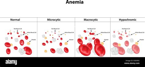 Hypochromic microcytic anaemia hi-res stock photography and images - Alamy