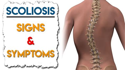 Scoliosis Signs & Symptoms | How to Identify Scoliosis - YouTube