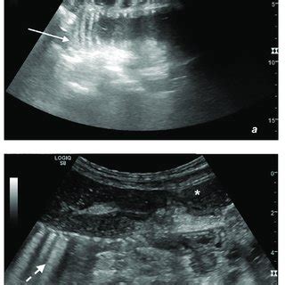 (PDF) Ultrasound of Small Bowel Obstruction: A Pictorial Review