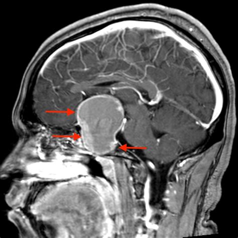 Prolactinoma Mimicking Migraine