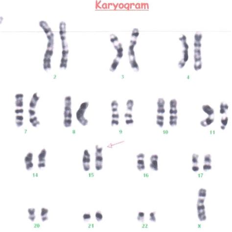 metaphase and karyotype showing translocation between chromosome 5 & X... | Download Scientific ...