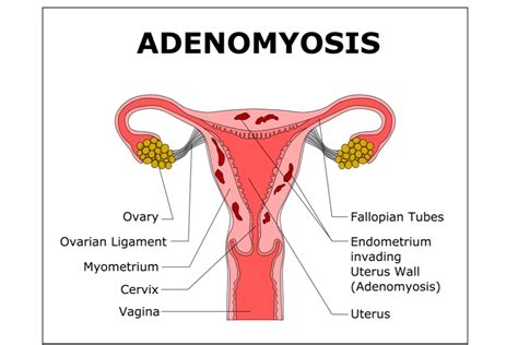 Adenomyosis-causes, symptoms & treatment - Qoctor your online doctor