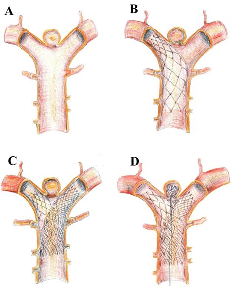 Stent-Assisted Techniques for Intracranial Aneurysms | IntechOpen