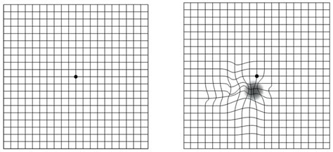 Amsler Grid Distortion Examples