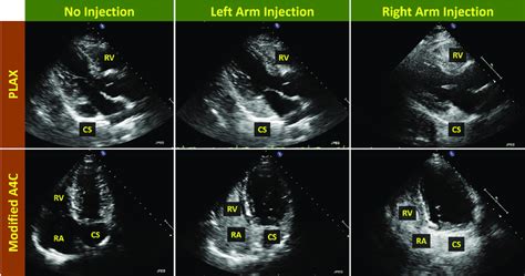 Case 2: persistent L-SVC, absent R-SVC. Transthoracic echocardiogram in... | Download Scientific ...