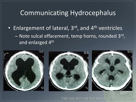 Hydrocephalus