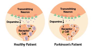 Understanding Parkinson's Disease | Brain Institute | OHSU