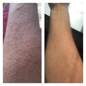 Before and after shot of my eczema, thanks Dupixent!!! : r/eczema