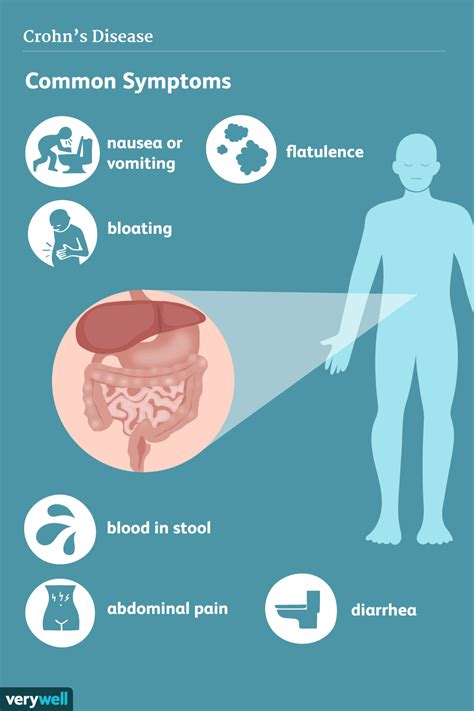 Crohn's Disease: Signs and Symptoms