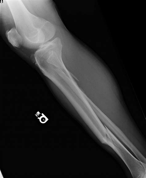 Broken Leg 2nd X-Ray : Biological Science Picture Directory – Pulpbits.net