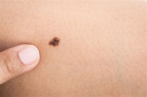 Dysplastic Nevus | Dermatology & Plastic Surgery in Palm Desert, CA ...