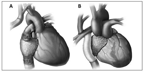 Life after Fontan palliation - Mayo Clinic