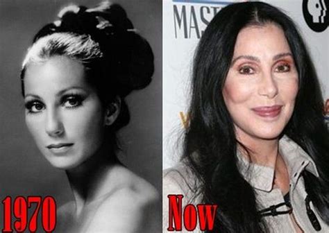 Cher before and after plastic surgery – Celebrity plastic surgery online