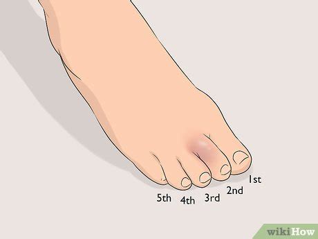 How to Buddy Tape an Injured Toe: 7 Steps (with Pictures)