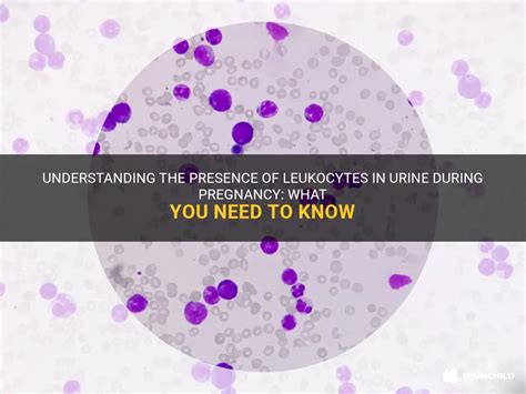 Understanding The Presence Of Leukocytes In Urine During Pregnancy: What You Need To Know ...