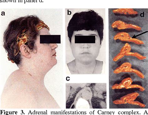 Figure 3 from Genetics of Carney complex and related familial ...