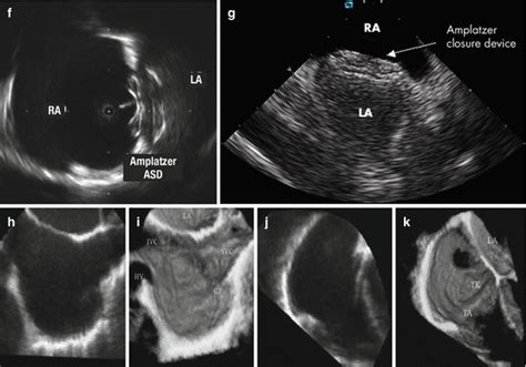 Intra-cardiac Echocardiography-Guided Interventional Imaging | Radiology Key