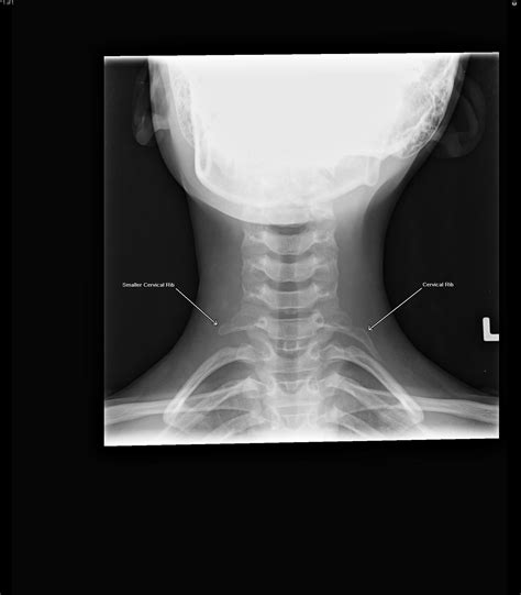 Cervical Ribs and Thoracic Outlet Syndrome | RADIOLOGYPICS.COM