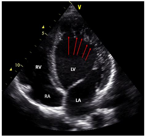 JCM | Free Full-Text | Noncompaction Cardiomyopathy—History and Current Knowledge for Clinical ...