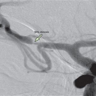 a: The right ICA angiography revealed stenosis of M1 and distal ICA ...