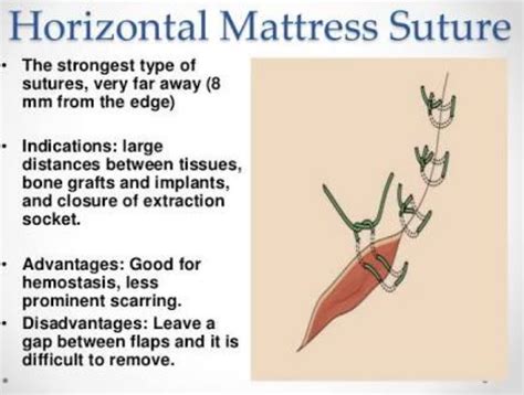 Horizontal Mattress Suture