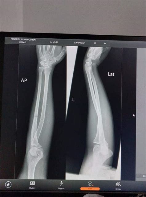 sharing the xray of my broken left arm. got a cast and will be removed ...