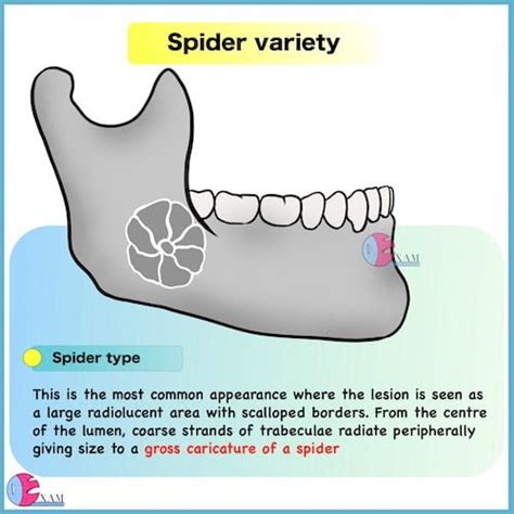 Ameloblastoma Radiology: Dental Radiology Notes