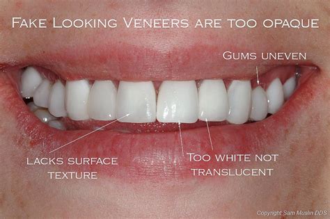 Fake-looking Veneers Veneers Teeth, Dental Veneers, Best Dentist, Dentist In, Dental Bonding ...