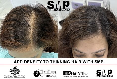 Scalp Micropigmentation for Women: Restoring Hairlines and Confidence