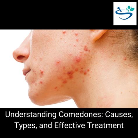 Comedones: Understanding the Types, Causes, and Treatment