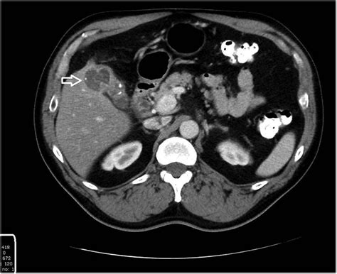 CT of the abdomen and pelvis with oral contrast revealing abnormal ...