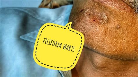 Warts on face , filiform warts removed - YouTube