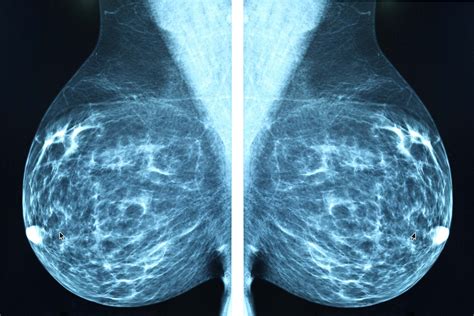 Abnormal Mammogram: Questions to Ask | Reader's Digest