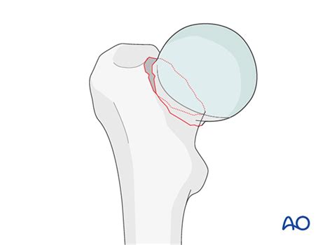 Displaced subcapital femoral neck fractures