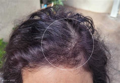 How To Take Biotin For Hair Growth, w/ Before & After Picture Results – Wholy Dose