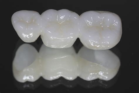 Zirconia Fixed Bridge | Albuquerque, NM | Precision Dental Care