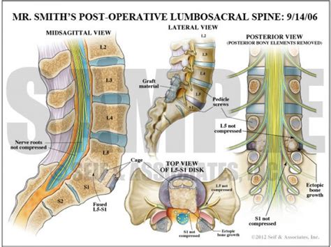 Lumbar Nerve Root Case Study - S&A Medical Graphics